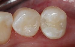 Figure 2: Immediate post-op restorations with Venus Pearl One (first premolar&mdash;no. 28 DO) and Venus Diamond One (second premolar&mdash;no. 29 MOD)