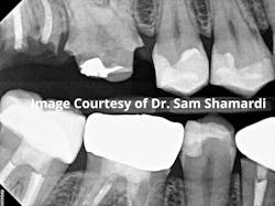 Close view of patient radiograph prior to treatment of teeth nos. 2 and 3