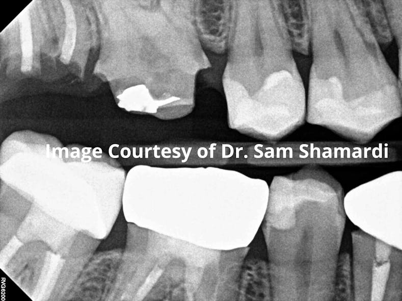 Close view of patient radiograph prior to treatment of teeth nos. 2 and 3