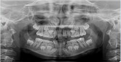 1611251748 2 Ddigitalpanoramicradiographof8yearoldfemaleatinitialconsultationfororthodonticevaluation Copy 1611251748 2 Ddigitalpanoramicradiographof8yearoldfemaleatinitialconsultationfororthodonticevaluation Copy