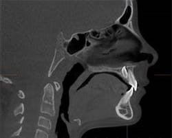 1611251775 Sagittalsliceofani Cat13x16cm Fov Quick Scan8 9secondsof Ur1tooth8andinvertedmesiodens 1611251775 Sagittalsliceofani Cat13x16cm Fov Quick Scan8 9secondsof Ur1tooth8andinvertedmesiodens