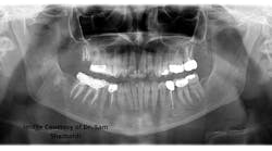 Patient radiograph prior to treatment of teeth nos. 2 and 3