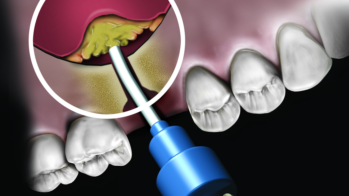 Current Concepts In Dental Bone Grafting Materials Dentistryiq