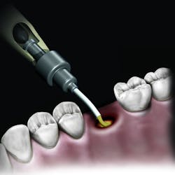 NovaBone Socket Grey NovaBone Socket Grey