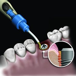 NovaBone TSV Implant Blue NovaBone TSV Implant Blue