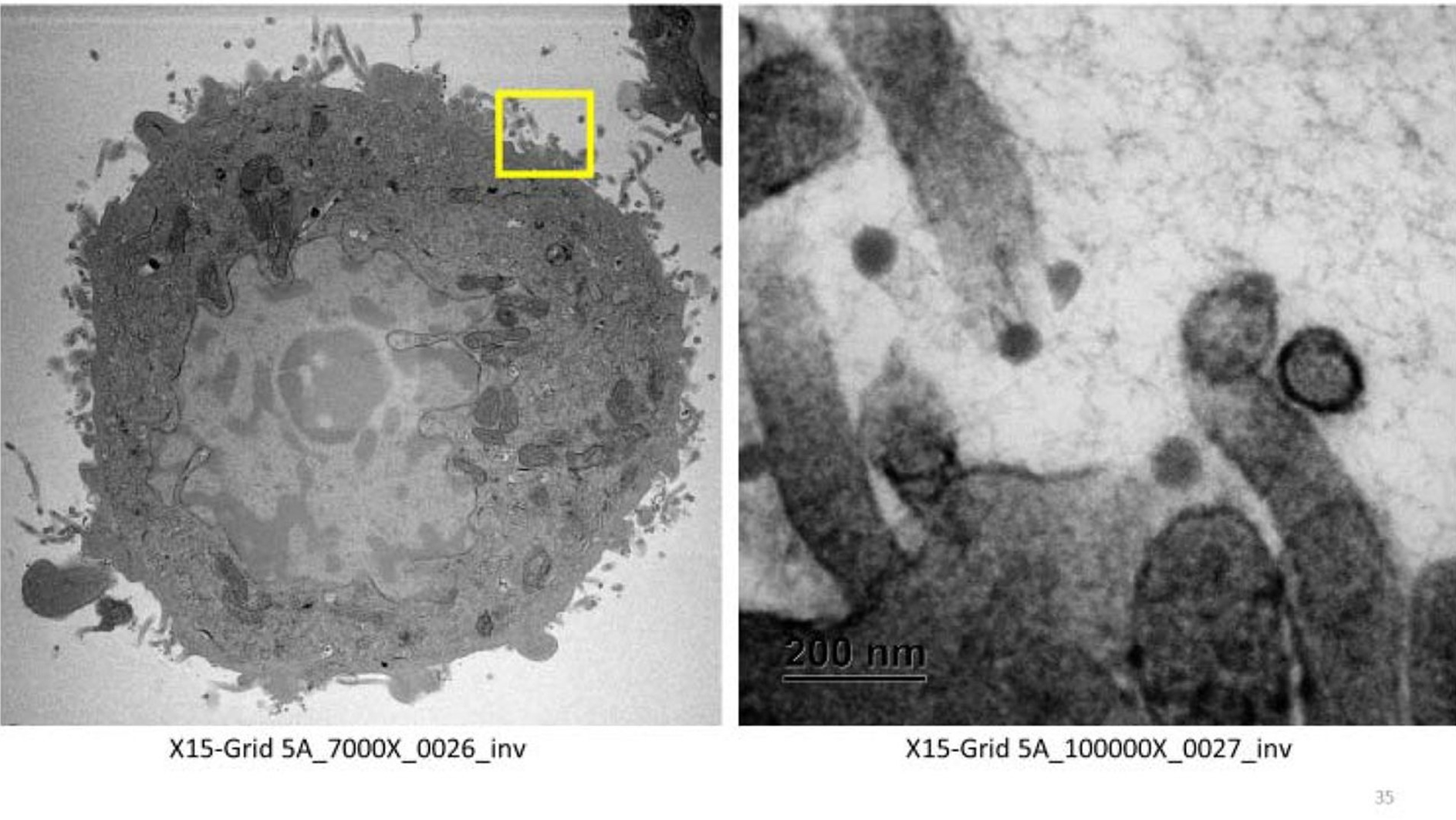 In electron microscope images captured during the study, SARS-CoV-2 was seen not attaching to cell walls in the presence of xylitol.
