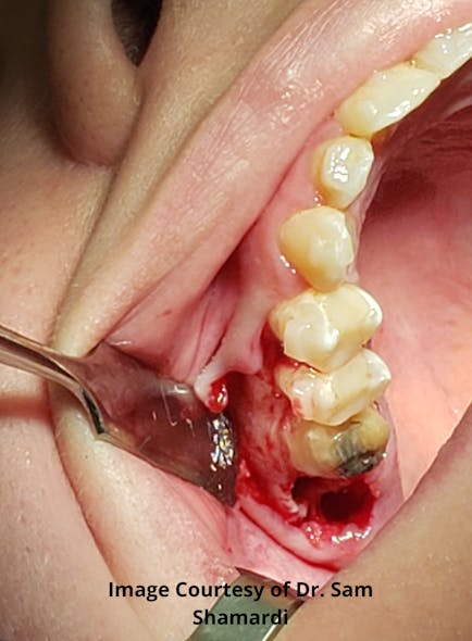 Surgical photo of extracted tooth no. 2 and lengthened tooth no. 3