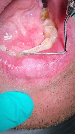 Ttl March 2021 Lip Pathology Pic Gividen Ttl March 2021 Lip Pathology Pic Gividen