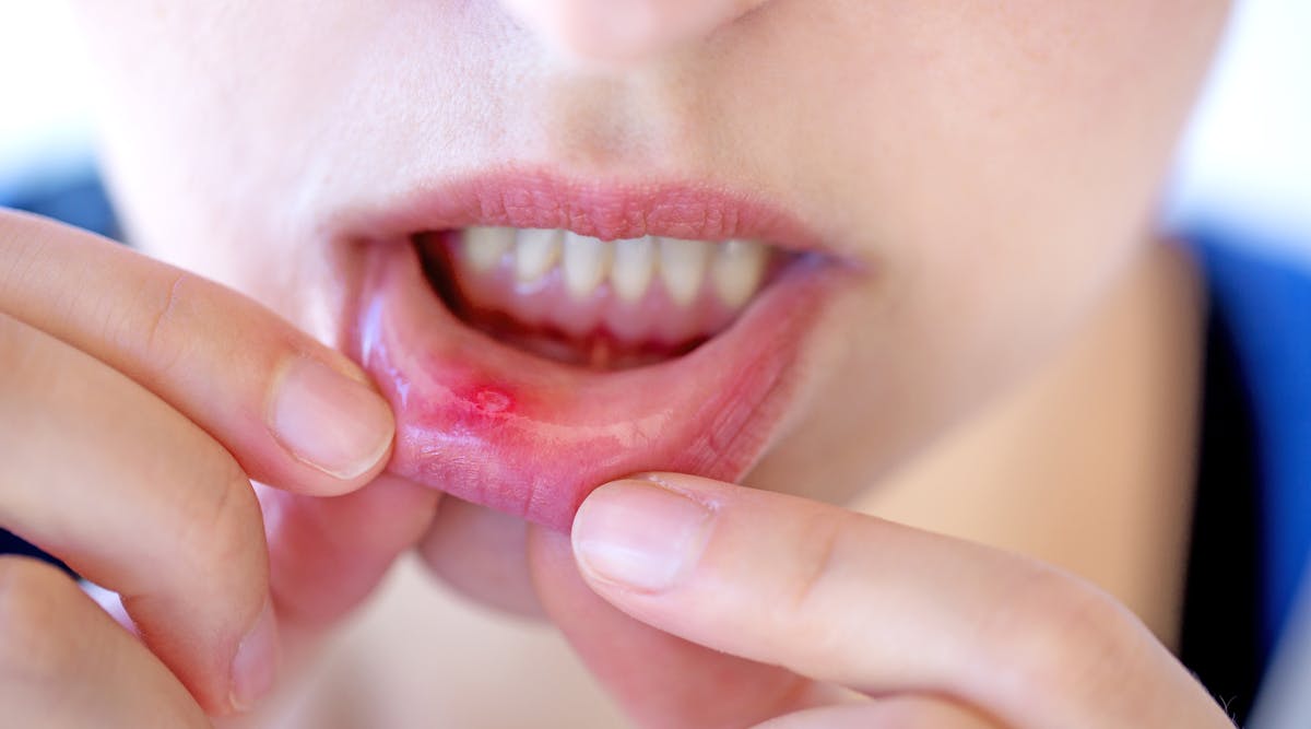 Inside of hot sale lip sore