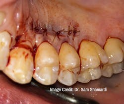 Sutured donor site Sutured donor site