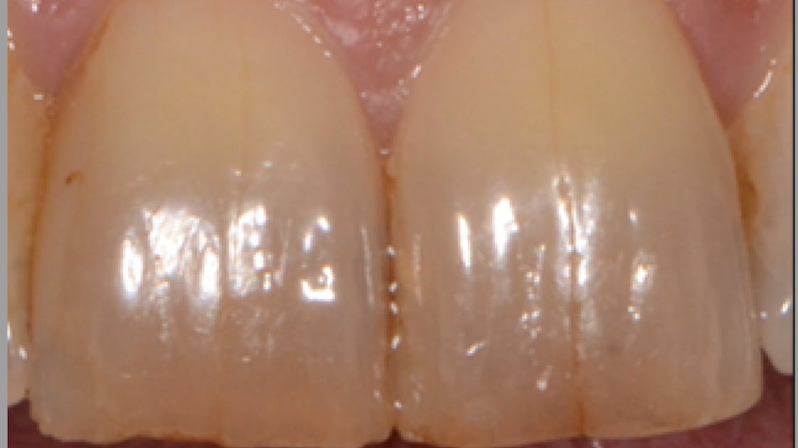 What are CRAZE LINES on Teeth & What to Do About Them 