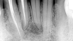 Ttl Cyst Lower Anterior 608ae1f983674 Ttl Cyst Lower Anterior 608ae1f983674