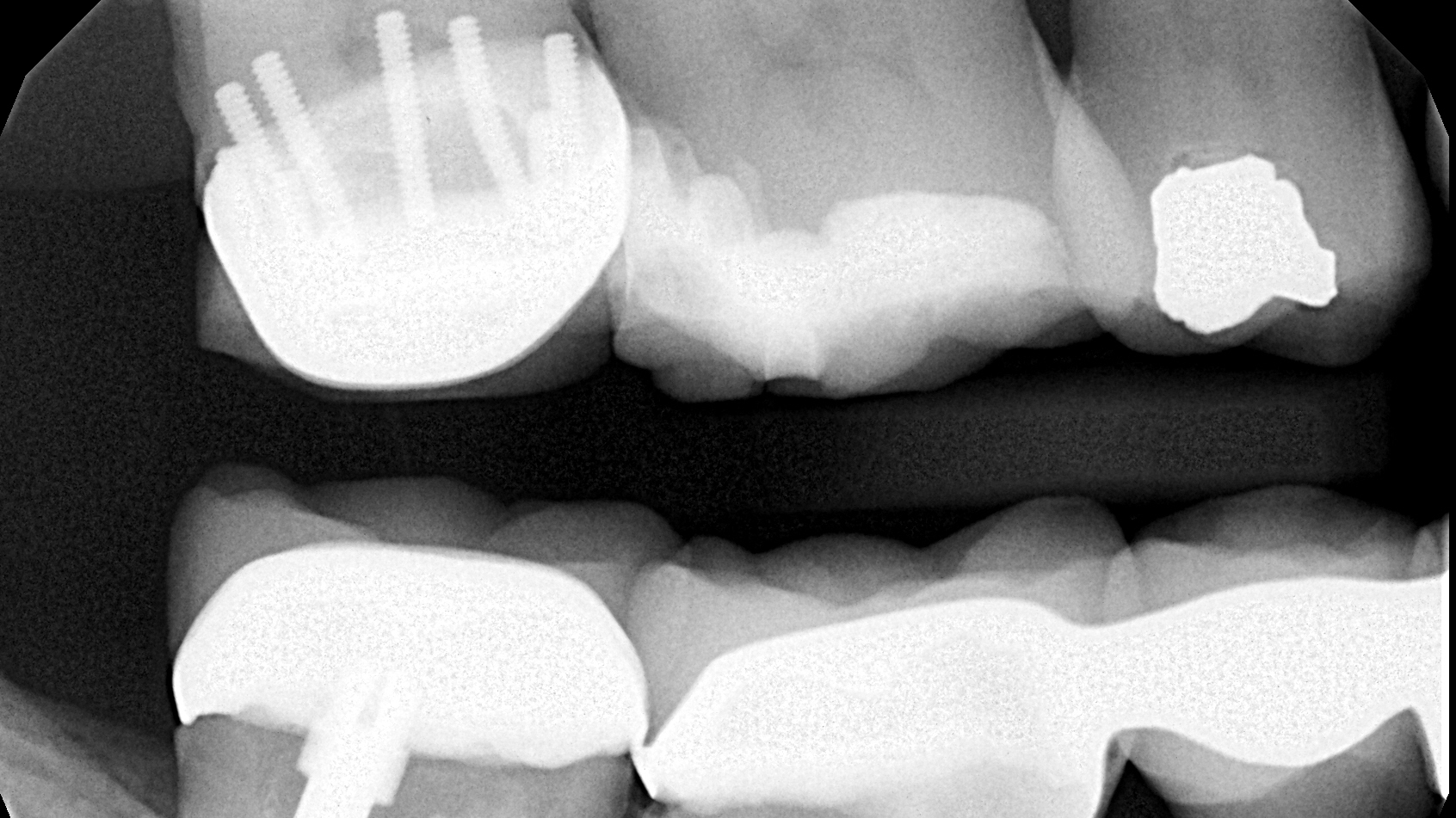 I spy...how many pins in this tooth? Dentistry IQ