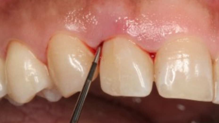 Staging, Grading, And Diagnosing Periodontitis | Dentistry IQ