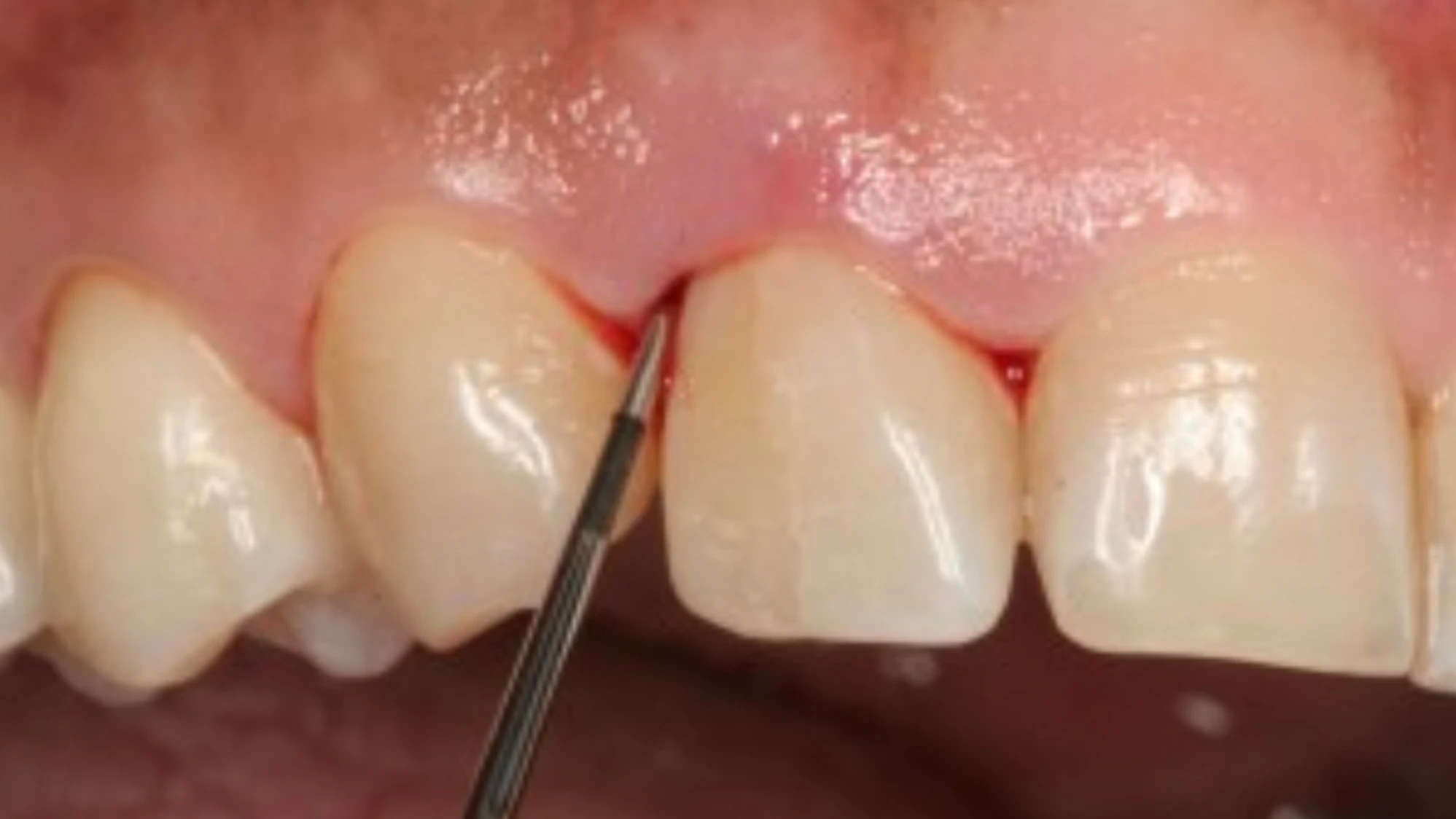 Staging, grading, and diagnosing periodontitis | Dentistry IQ