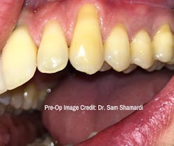 Pre-operatory photo; patient is concerned about esthetics of tooth no. 11 Pre-operatory photo; patient is concerned about esthetics of tooth no. 11