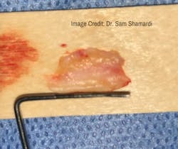 Harvested connective donor tissue Harvested connective donor tissue