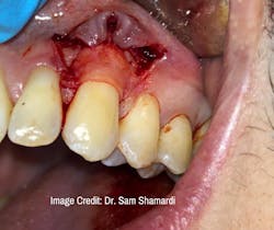 Donor tissue placed around tooth no. 11 Donor tissue placed around tooth no. 11