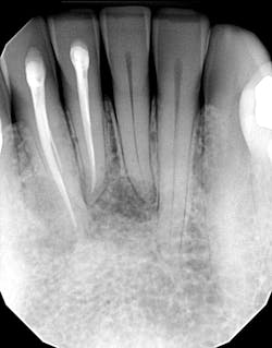 Ttl Cyst Lower Anterior Ttl Cyst Lower Anterior