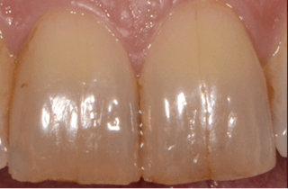 From Chips To Craze Lines: All About Cracked Teeth