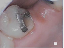 Figure 2: A cusp fracture of a maxillary tooth on the tongue side
