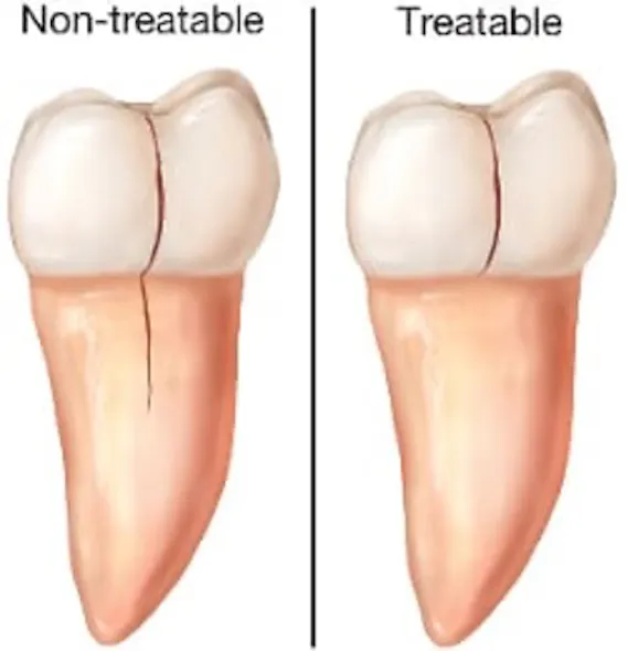 Cracked tooth: Types, causes, and treatments | Dentistry IQ