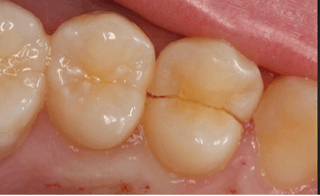 5 Dental Procedures to Repair Your Cracked or Broken Tooth