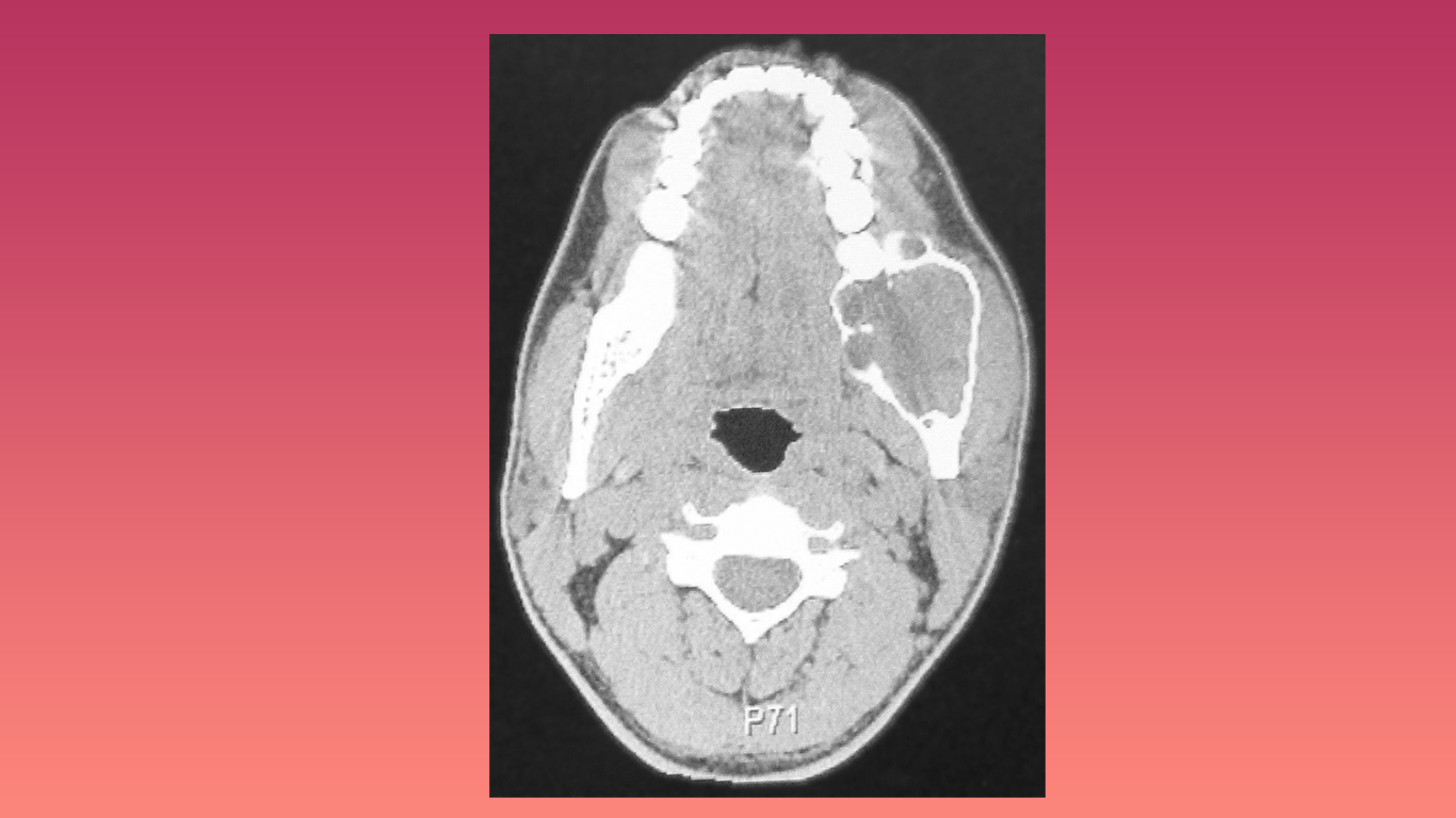 CT scan of ameloblastoma
