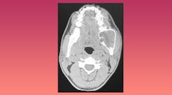 CT scan of ameloblastoma