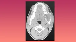 CT scan of ameloblastoma