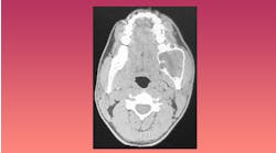 CT scan of ameloblastoma