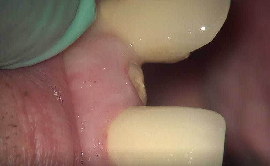 Figure 1: Clinical presentation of fractured maxillary lateral incisor