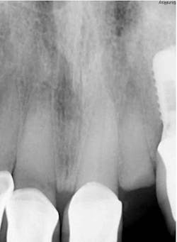 Figure 2: Pre-op clinical radiograph no. 10 with oblique fracture to osseous crest Figure 2: Pre-op clinical radiograph no. 10 with oblique fracture to osseous crest