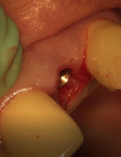 Figure 3: Postoperative clinical photograph Figure 3: Postoperative clinical photograph