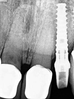 Figure 5: Postoperative abutment Figure 5: Postoperative abutment