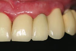 Figure 6: Final restoration in the mouth Figure 6: Final restoration in the mouth