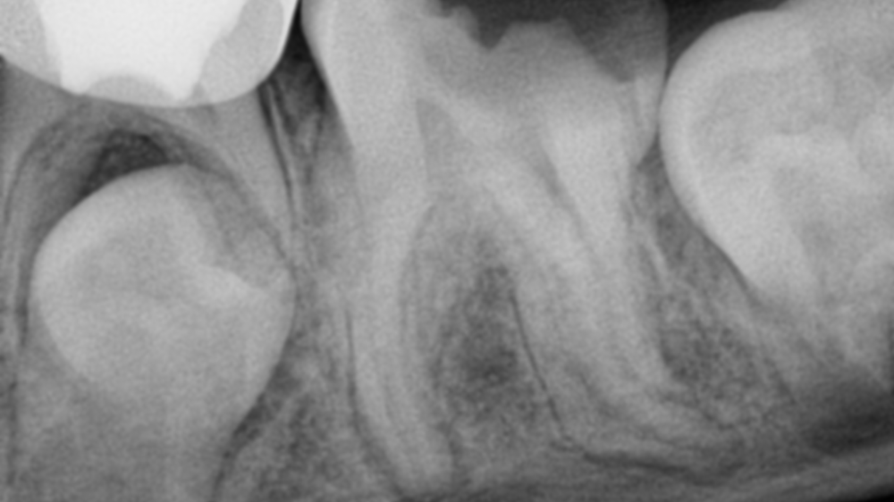 Ttl #19 Pull Or Extract