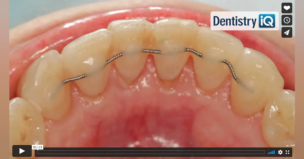 Fixed Retention Best Practices for Best Practices: 6 steps to fixed ortho retention ...