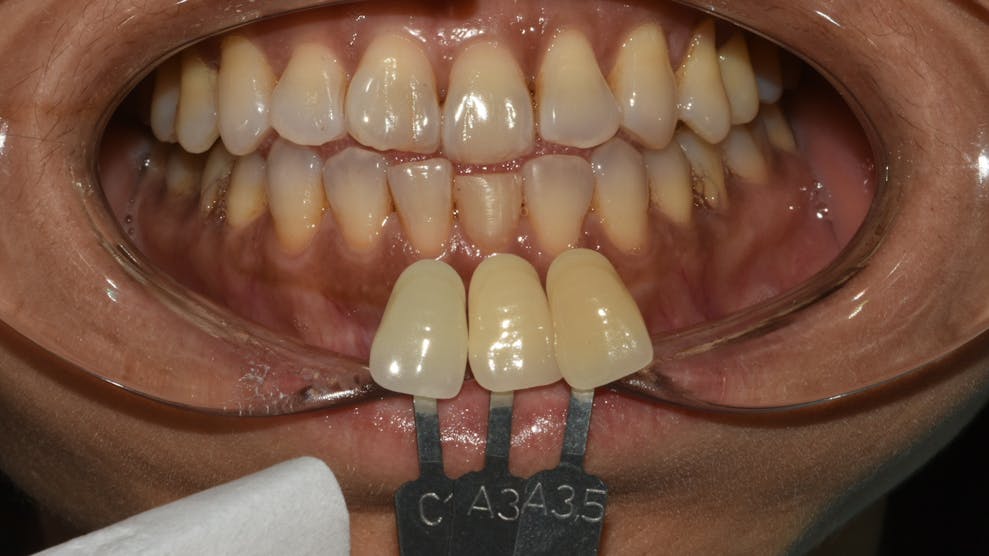 A Review of Color Science in Dentistry: The Process of Color Vision
