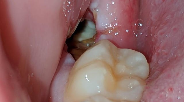 Dry Socket Healing Time