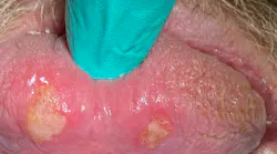 Extreme Case Of Oral Herpes