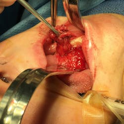 Post-op: Ranula Post-op: Ranula