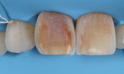 Figure 2: Papillary retraction obtained when the heavy-gauge dam is inverted Figure 2: Papillary retraction obtained when the heavy-gauge dam is inverted