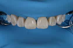 Figure 3: Premolar clamps placed over the dam to affix it Figure 3: Premolar clamps placed over the dam to affix it