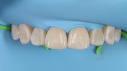 Figure 4: A rubber cord, such as Wedjets (Coltene), can be flossed between the contact of the most distal teeth to be isolated and left in place. Figure 4: A rubber cord, such as Wedjets (Coltene), can be flossed between the contact of the most distal teeth to be isolated and left in place.