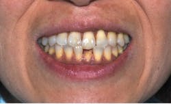 Figure 1: Patient presented with a chipped lower left central incisor with a fair to good prognosis Figure 1: Patient presented with a chipped lower left central incisor with a fair to good prognosis