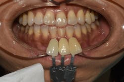 Figure 2: Reference photo with two to three shade tabs to determine the cervical color of adjacent teeth after the core build-up was completed Figure 2: Reference photo with two to three shade tabs to determine the cervical color of adjacent teeth after the core build-up was completed