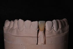 Figure 3: Final crown seated on master cast Figure 3: Final crown seated on master cast