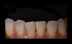 Figure 5: Close-up view after cementation Figure 5: Close-up view after cementation