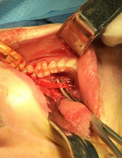 Post-op: Ranula Post-op: Ranula